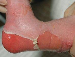 Epidermólise bolhosa e o Noeh